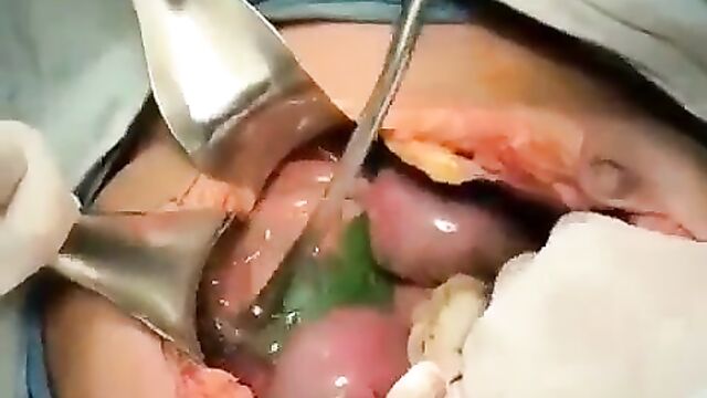 Doctors Remove Big Cucumber From Stomach Of Woman Caught Fucking Herself With Bottle And Cucumber - 1 image