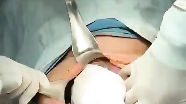 Doctors Remove Big Cucumber From Stomach Of Woman Caught Fucking Herself With Bottle And Cucumber - 3 image