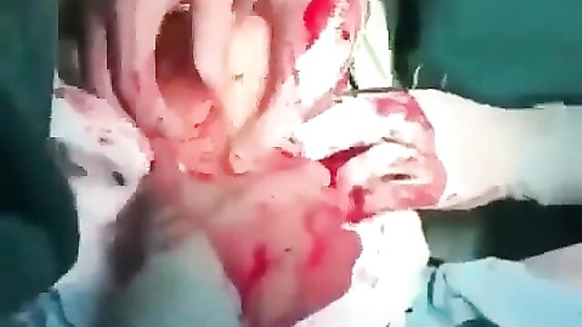 The Doctors Remove Dildo Sex Toy From Woman’s Stomach - 1 image