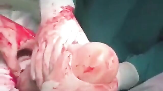 Doctors remove very big dildo sex toy from woman’s body - 2 image