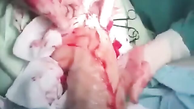 Doctors remove very big dildo sex toy from woman’s body - 3 image